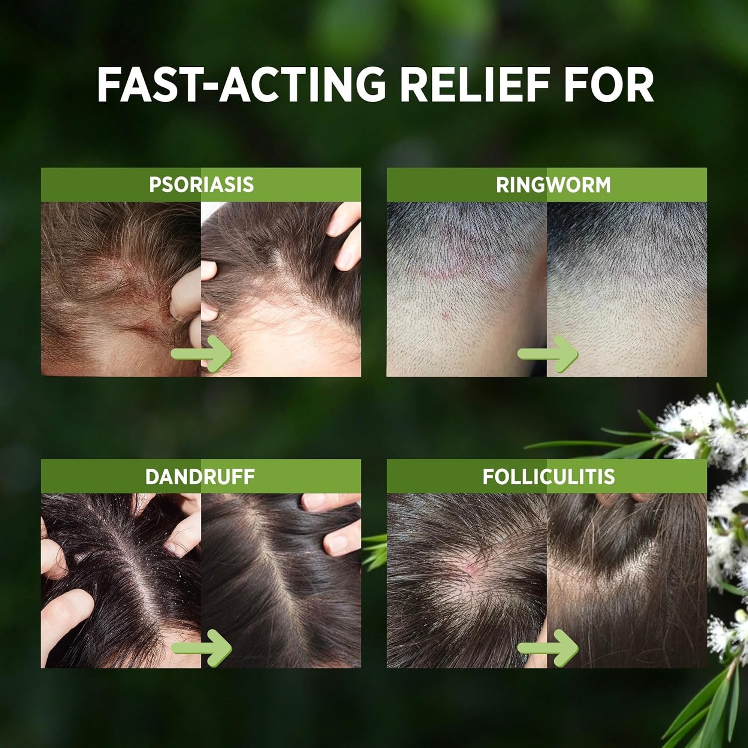 RoyceDerm Tea Tree Scalp Relief Spray: Leave-In Scalp Care for Dry, Flaky, an…