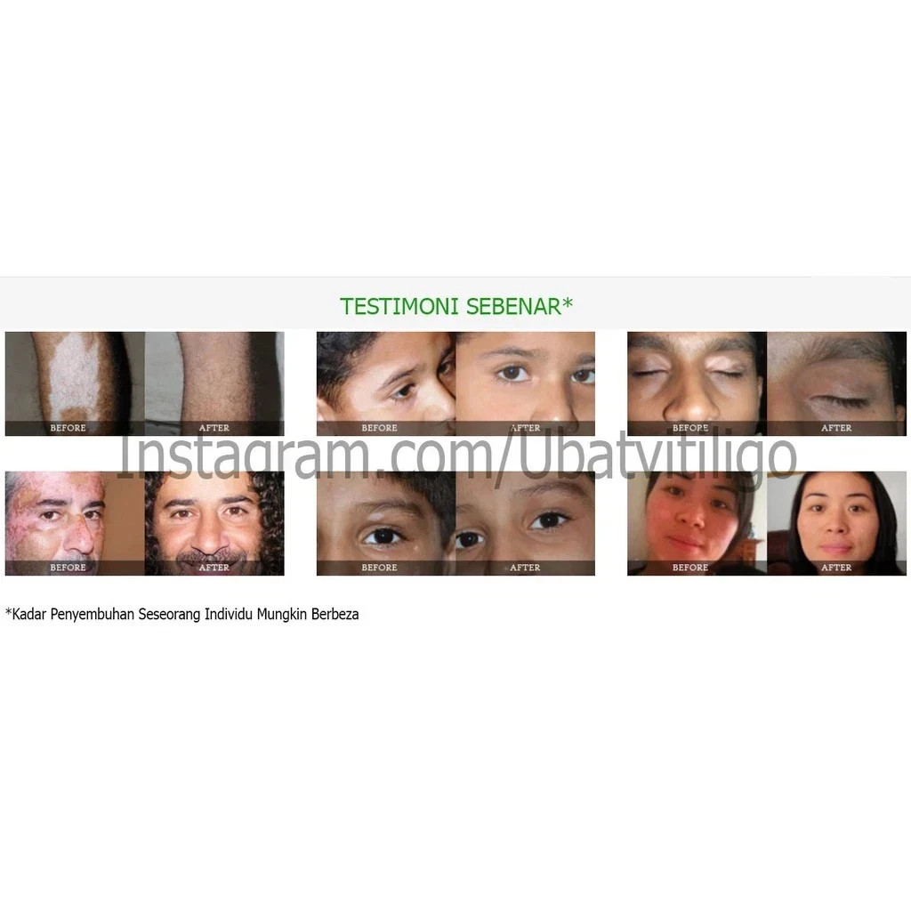 1x Vitiligo Organics Naturally 30ml for White Spots Skin Repair RePigmentation