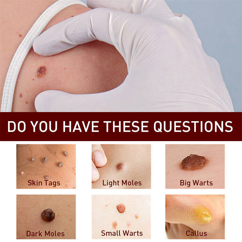 «FINAL SAL» Skin Tags & Moles Removal Quick Safe Remover Restore Skin 3ml US