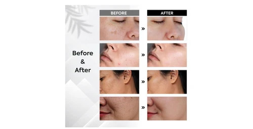 Share Dark Spot Remover for Face and Body Musely Dark Spot Remover for Melasma S