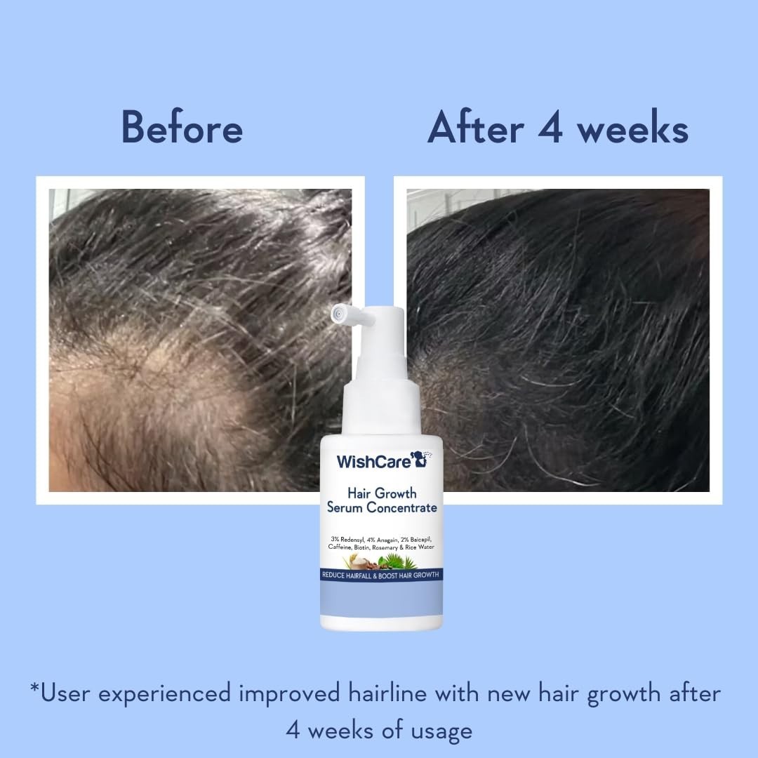 WishCare Hair Growth Serum For Scalp | 94% Saw New Hair Growth | 30ml