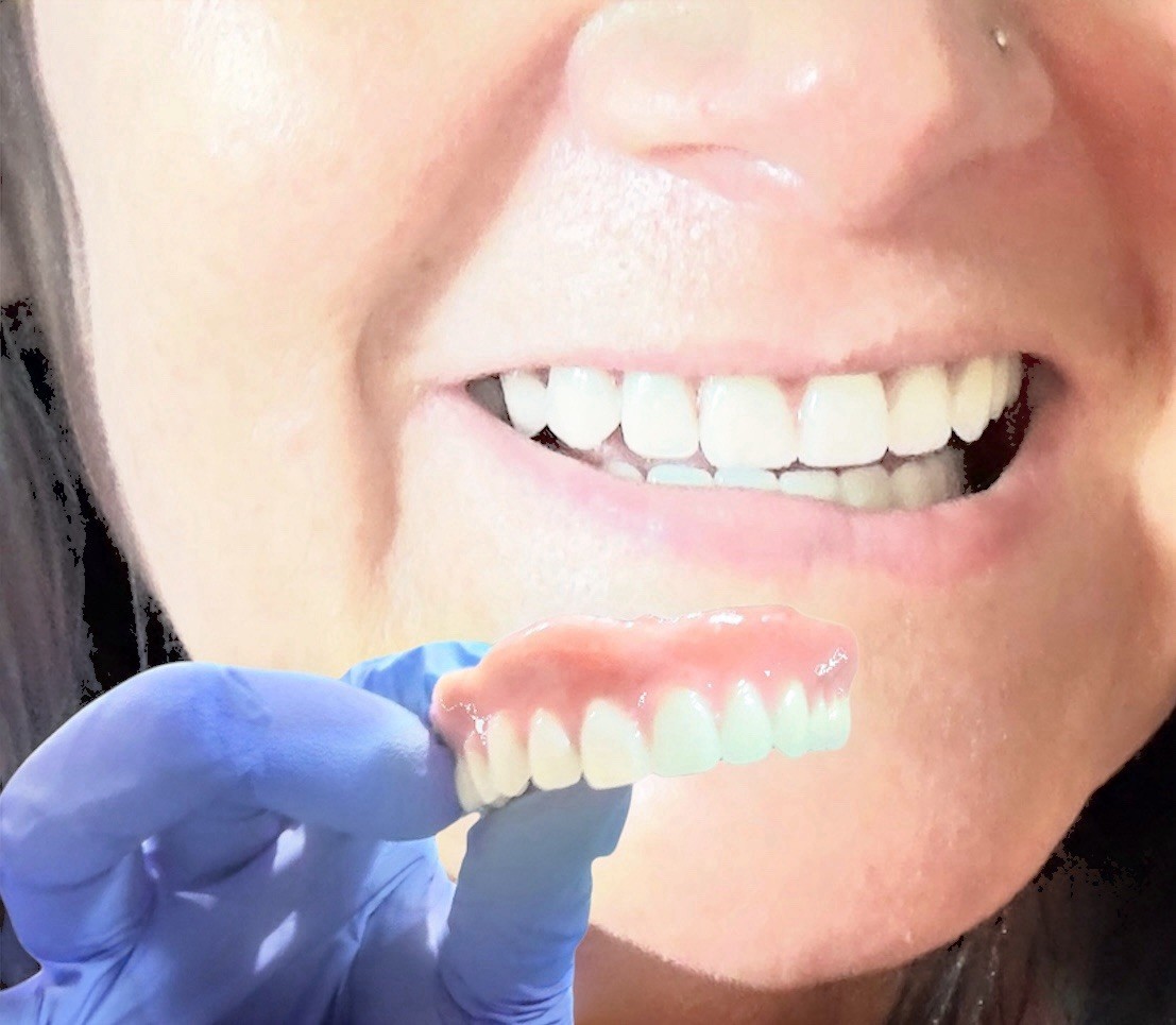 DIY Dental Denture Kit Full Partial Make At Home Missing Teeth A1 A2 A3 USA