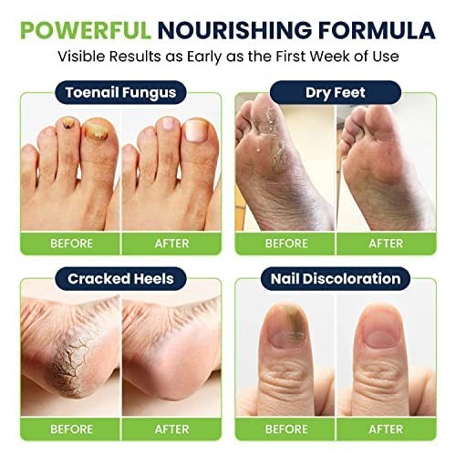 Ultimate Nail Care Bundle – Extra Strength Treatment for Toenails & Fungus