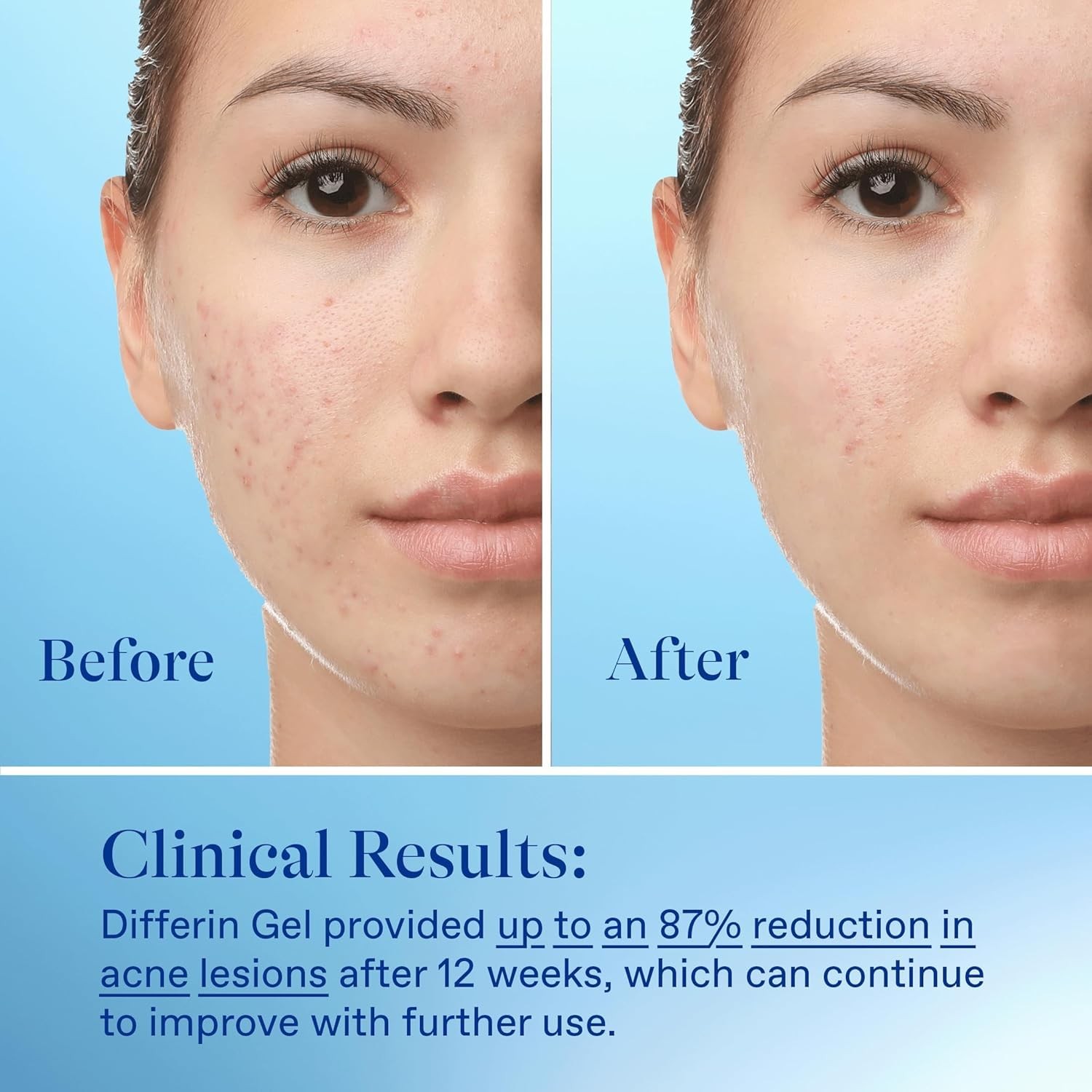 Acne Treatment Gel, 30 Day Supply, Retinoid Treatment for Face with 0.1% Adapale