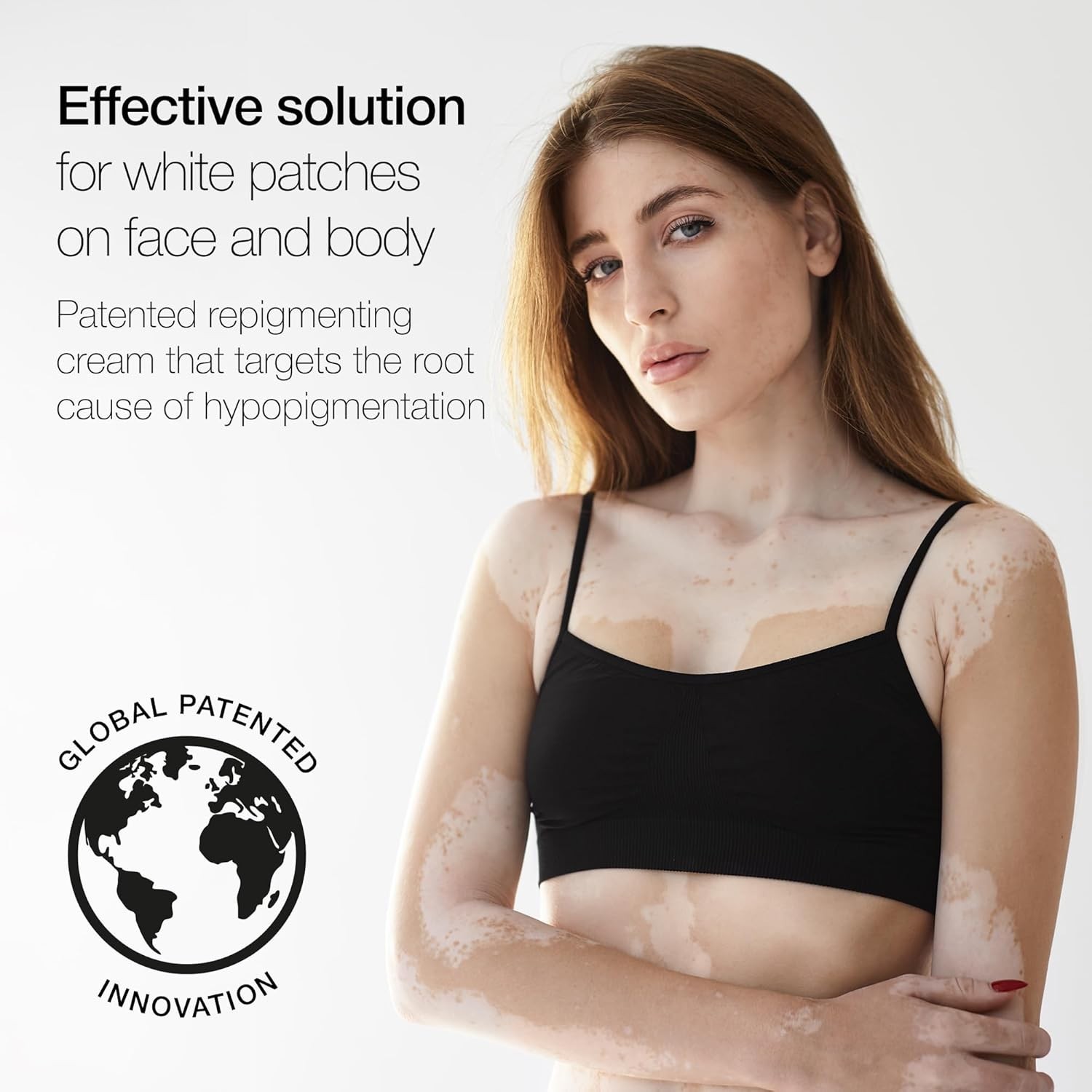 Repigment12: Dermatologist-Tested White Patch Corrector=