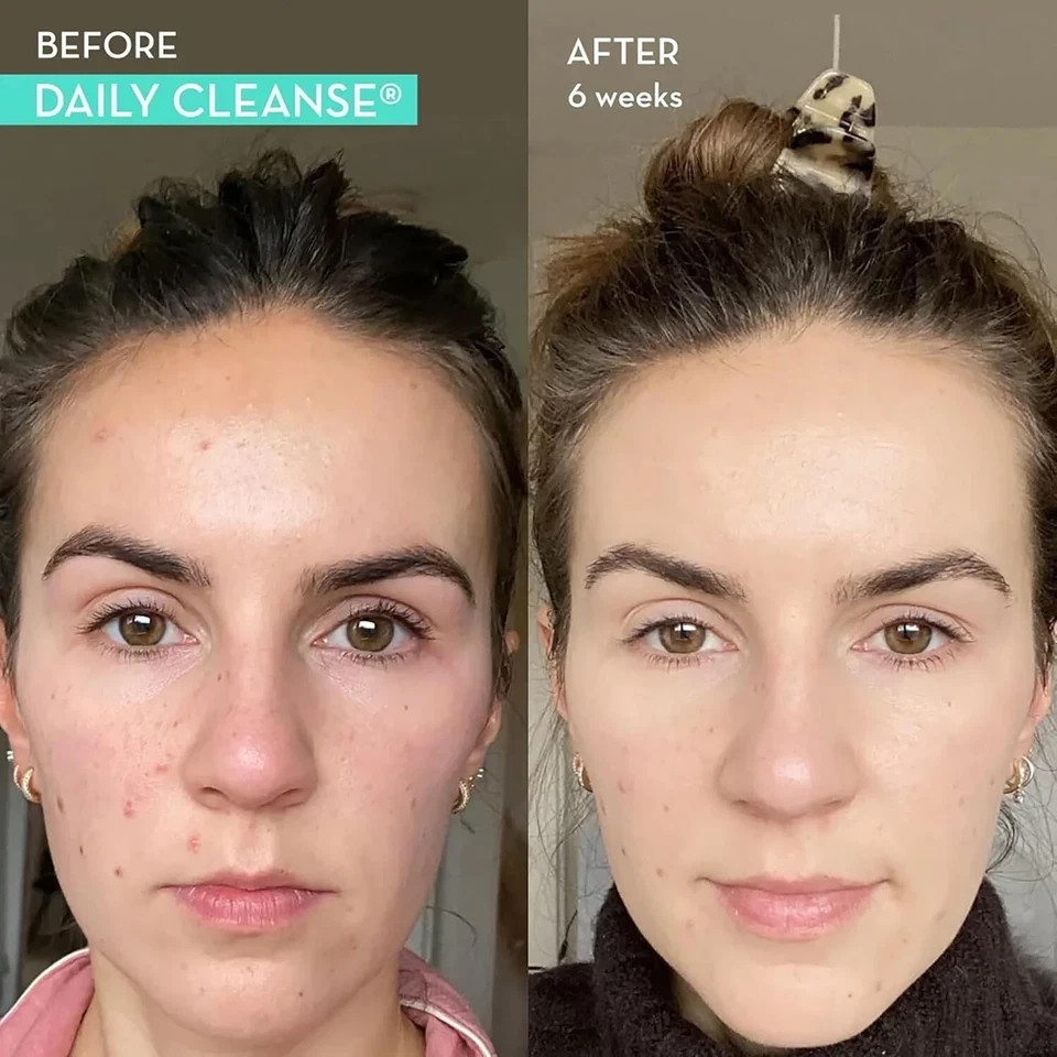 HUM Daily Cleanse Acne Supplement – 60 Capsules Free Shipping US