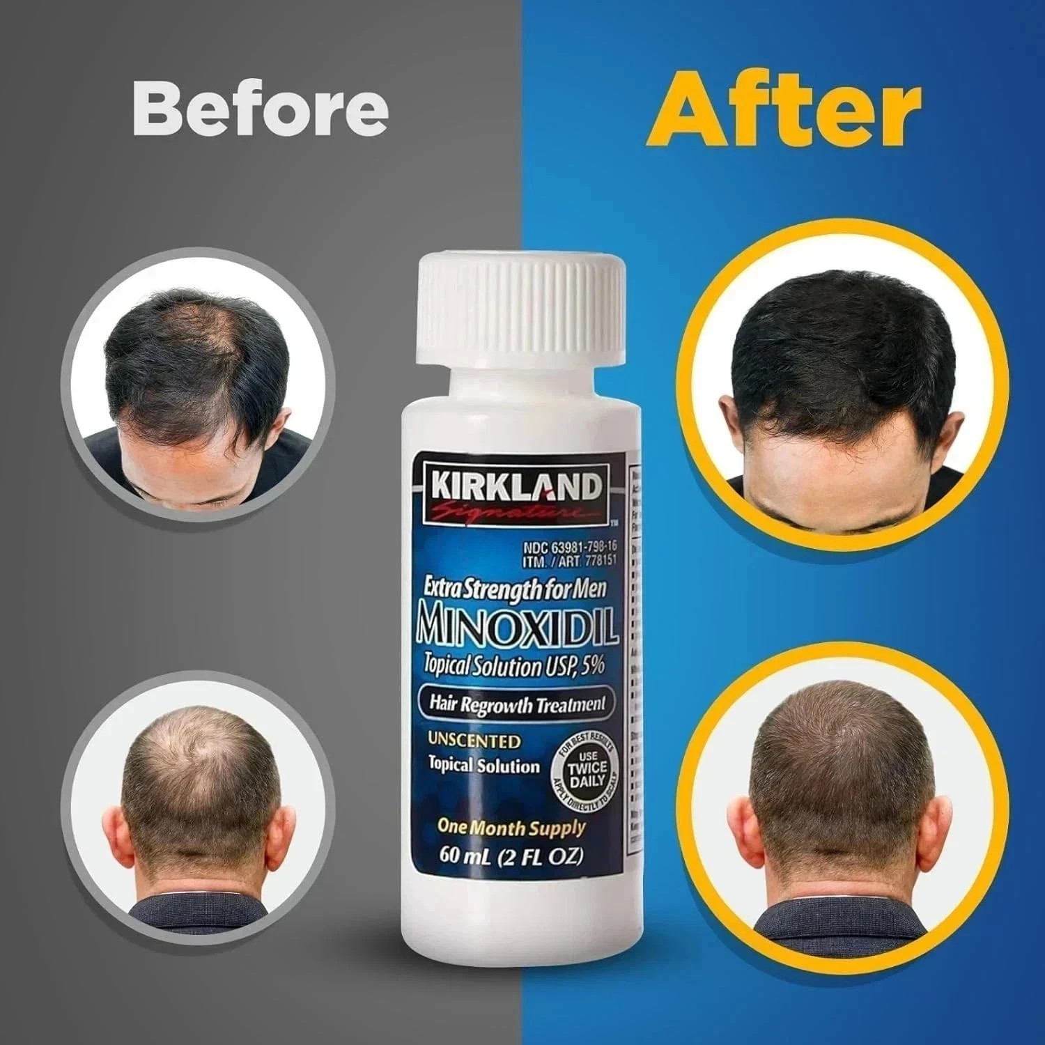 Minoxidil 5% Extra Strength Men 6 Month Supply Hair Regrowth Solution Fast Ship
