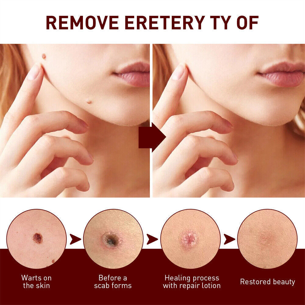 «FINAL SAL» Skin Tags & Moles Removal Quick Safe Remover Restore Skin 3ml US