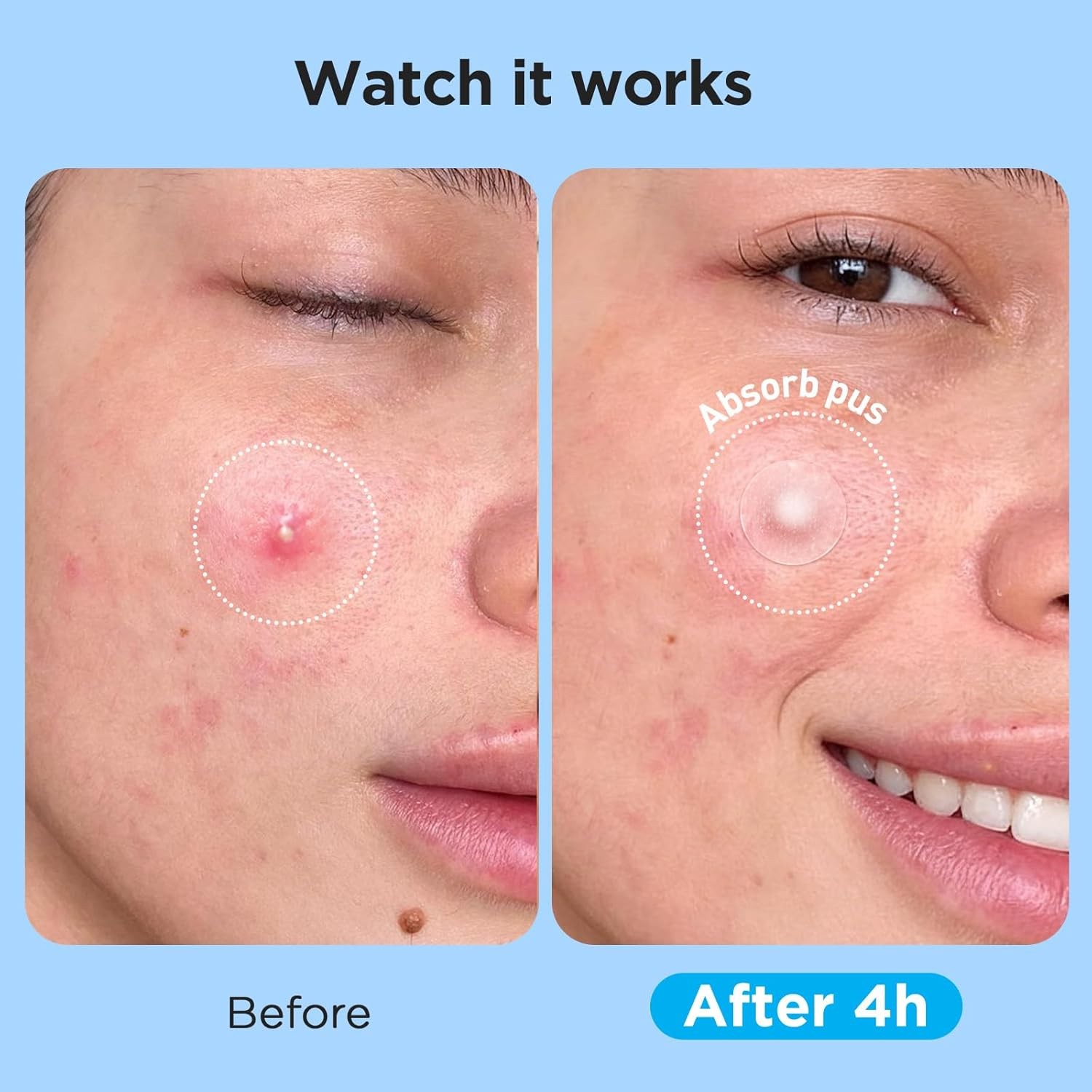 COSRX 24EA2 Acne Pimple Master Patch Sheets