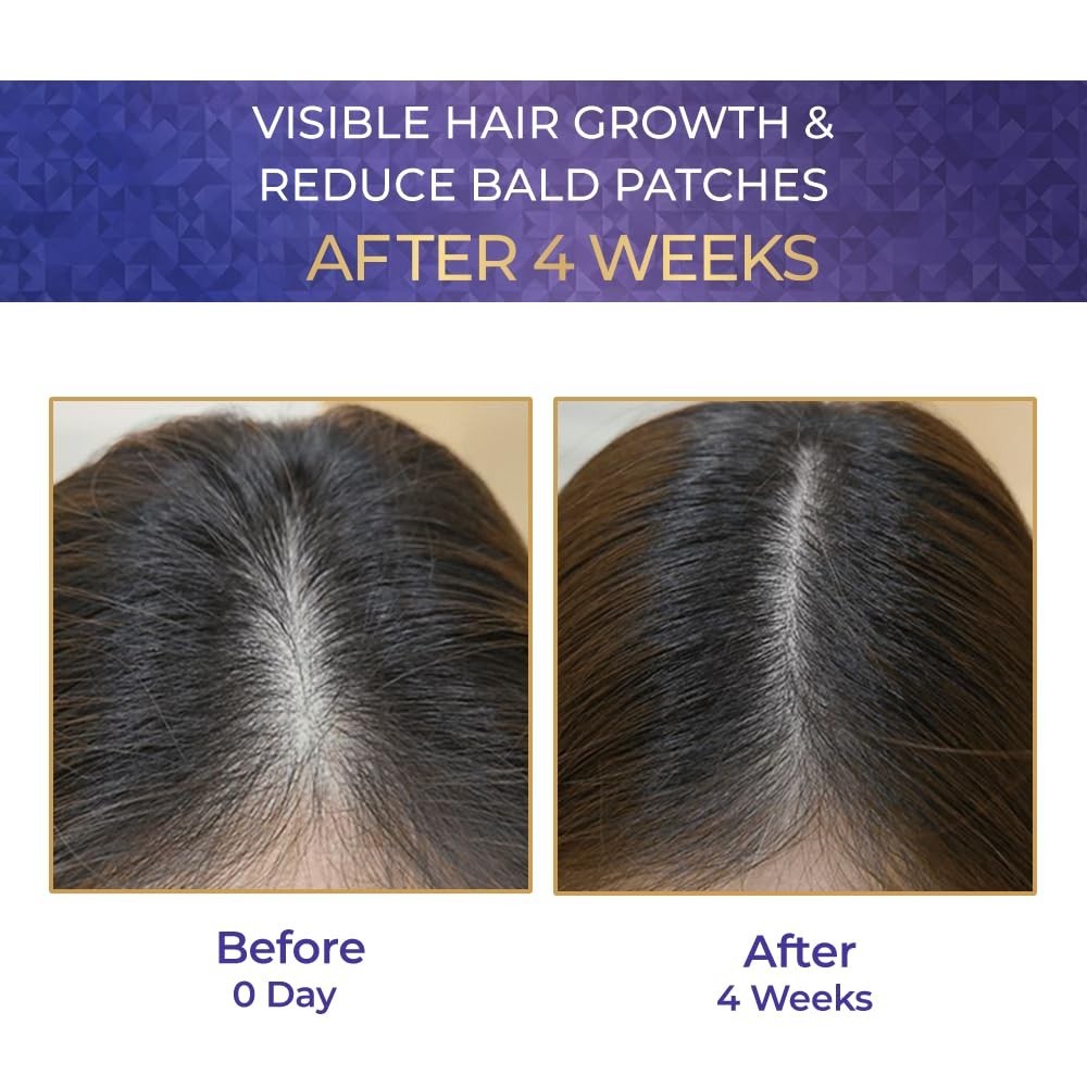 Streax Hair Growth Serum for Scalp, 30 ml with 3% Redensyl, 3% Anagain