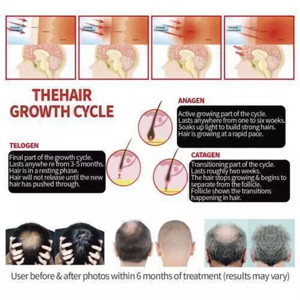 US 650nm Red LED Light Therapy Hat Hair Loss Treatment Cap Hair Growth Regrowth