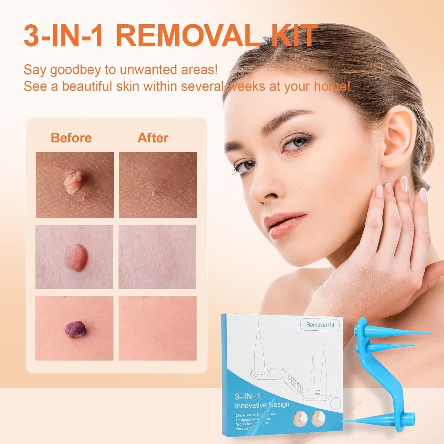 3 in 1 Auto Skin Tag Remover Device Kit Wart Painless Removal 1-8 mm Bands Tool