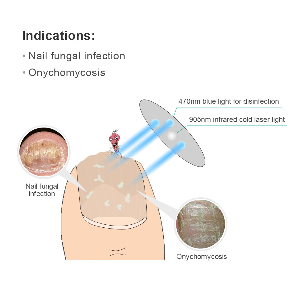 Nail Fungus Treatment Laser Therapy Device Fungal Onychomycosis Infection FD A
