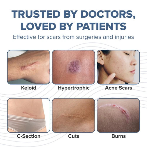 Prosil Silicone Scar Stick 4.25G – Effective Scar Treatment With Premi