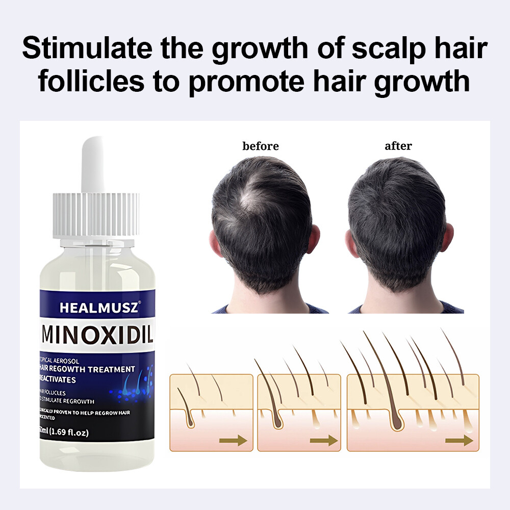 Minoxidil 5% Extra Strength for Men&Women Hair Regrowth Solution 6 Month Supply