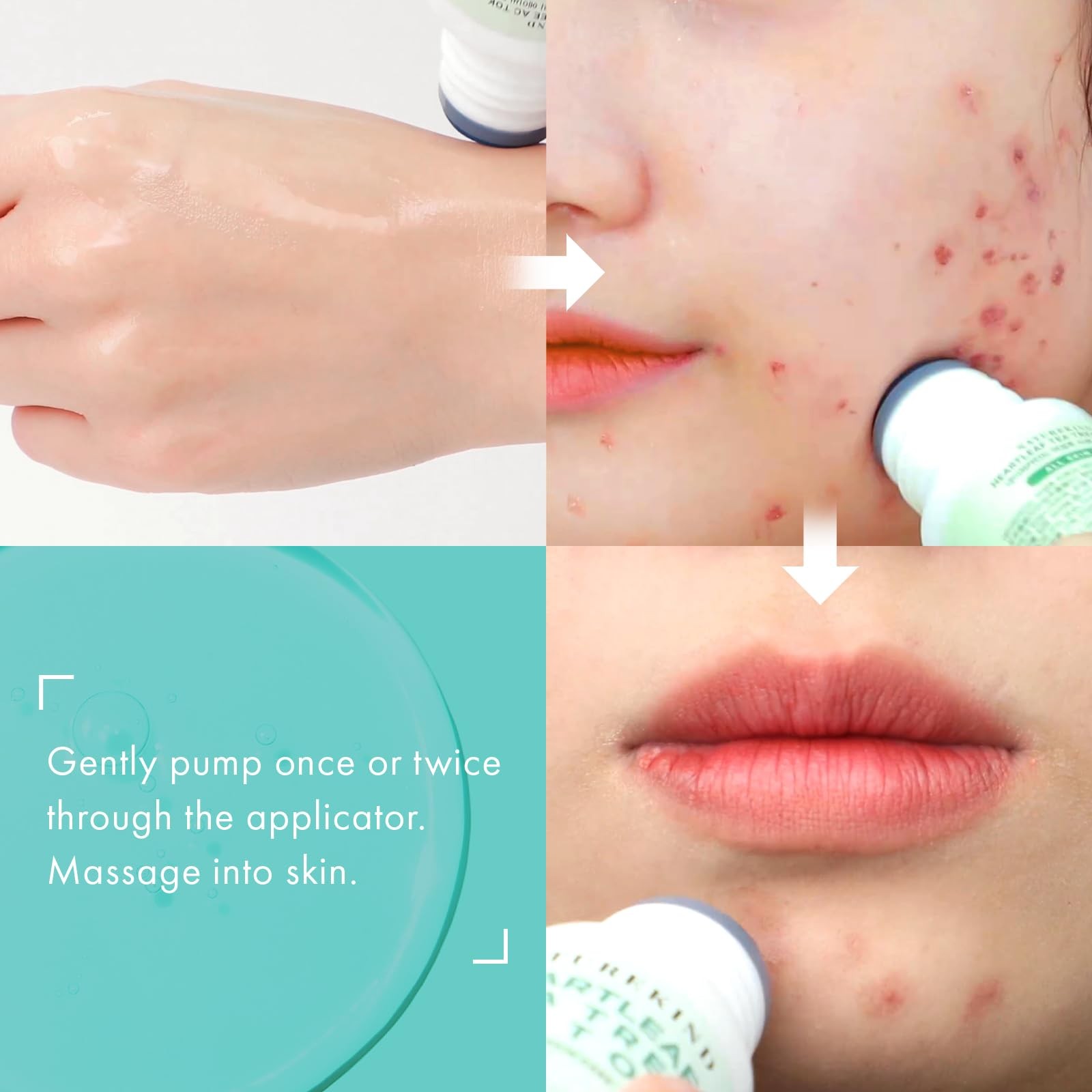 Naturekind Heartleaf Tea Tree Tok Acne Treatment Soothing Toner Serum Centella