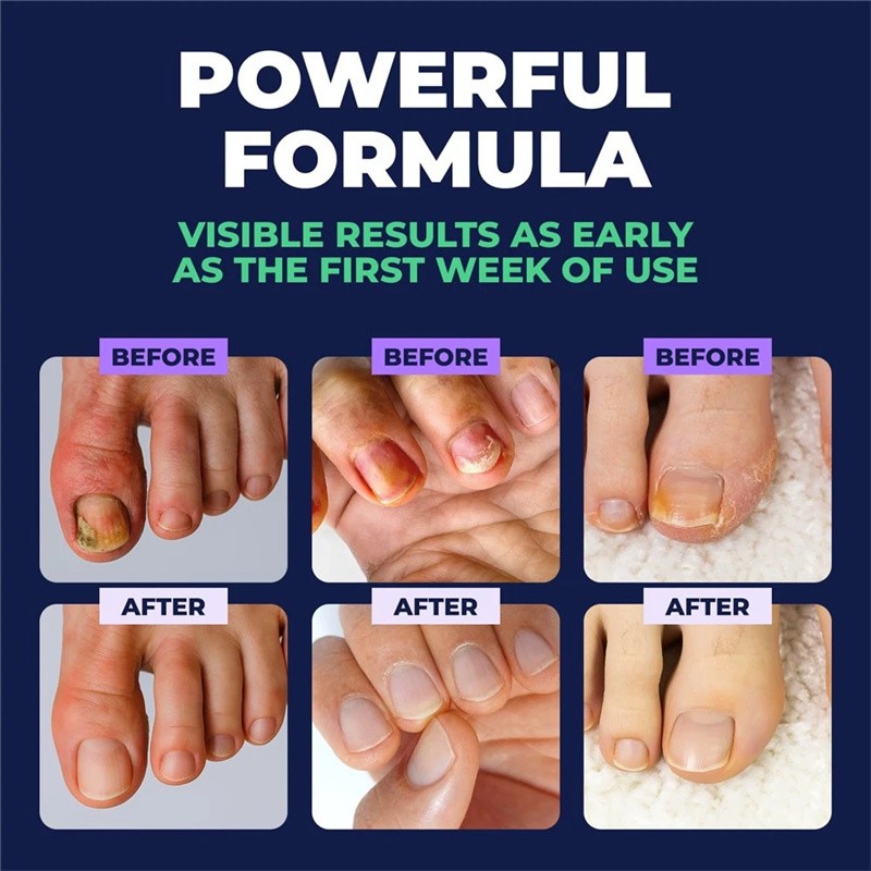 5Pcs NEW Anti Fungal Pen Intensive Treatment Toenail Fungus Foot Nail Repair Oil