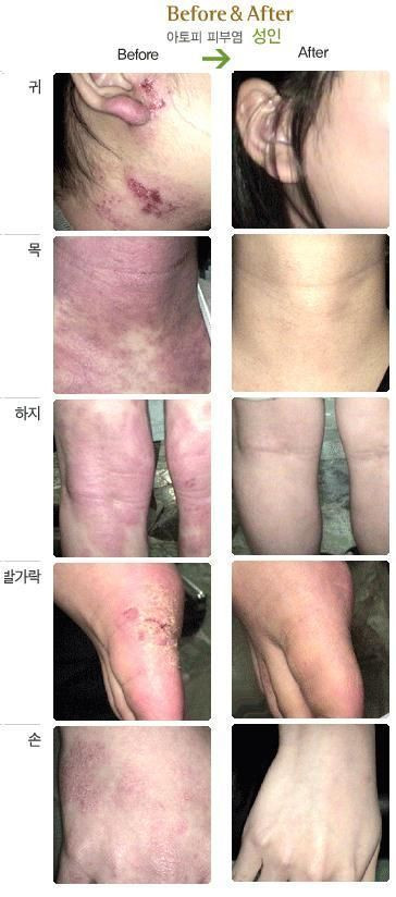 3 Lot of ISAL Atopy Eczema Cream Lotion./Made in USA