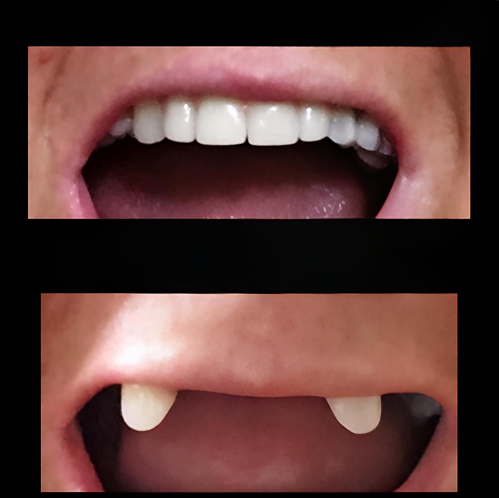 Partial Denture Kit Make Your Own Custom Denture Affordable Temporary Teeth A2