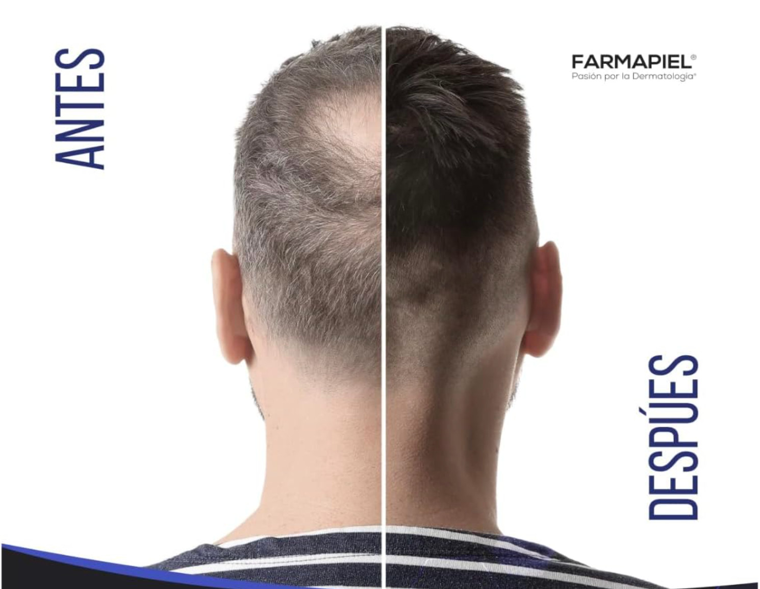Solución 5% Anacastel, Tratamiento Capilar Anticaída Cabello, Barba y Bigote
