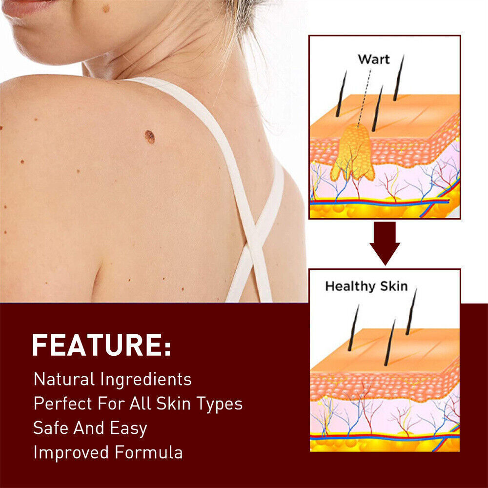 «FINAL SAL» Skin Tags & Moles Removal Quick Safe Remover Restore Skin 3ml US