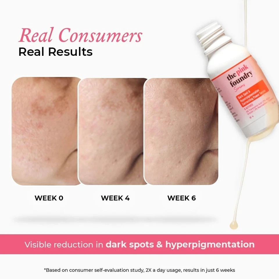 The Pink Foundry Dark Spot & Hyperpigmentation Serum For Men & Women 30 ml