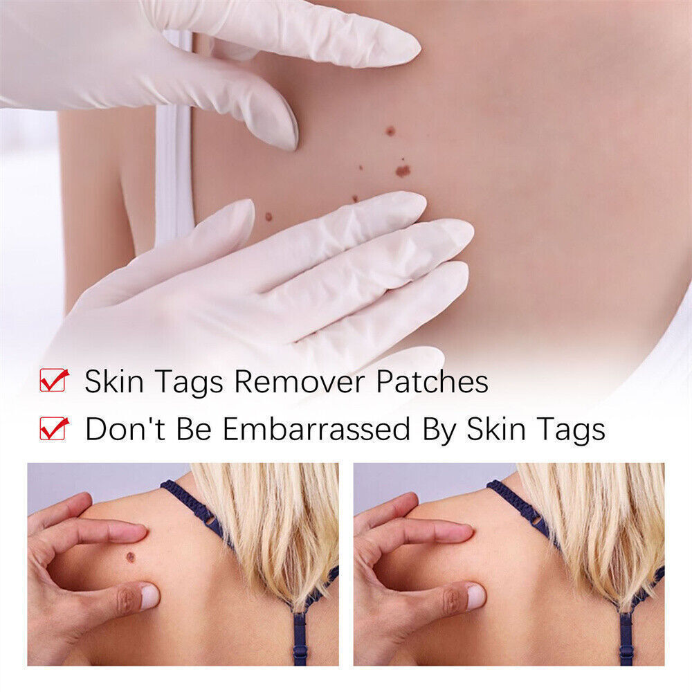 «FINAL SAL» Skin Tags & Moles Removal Quick Safe Remover Restore Skin 3ml US