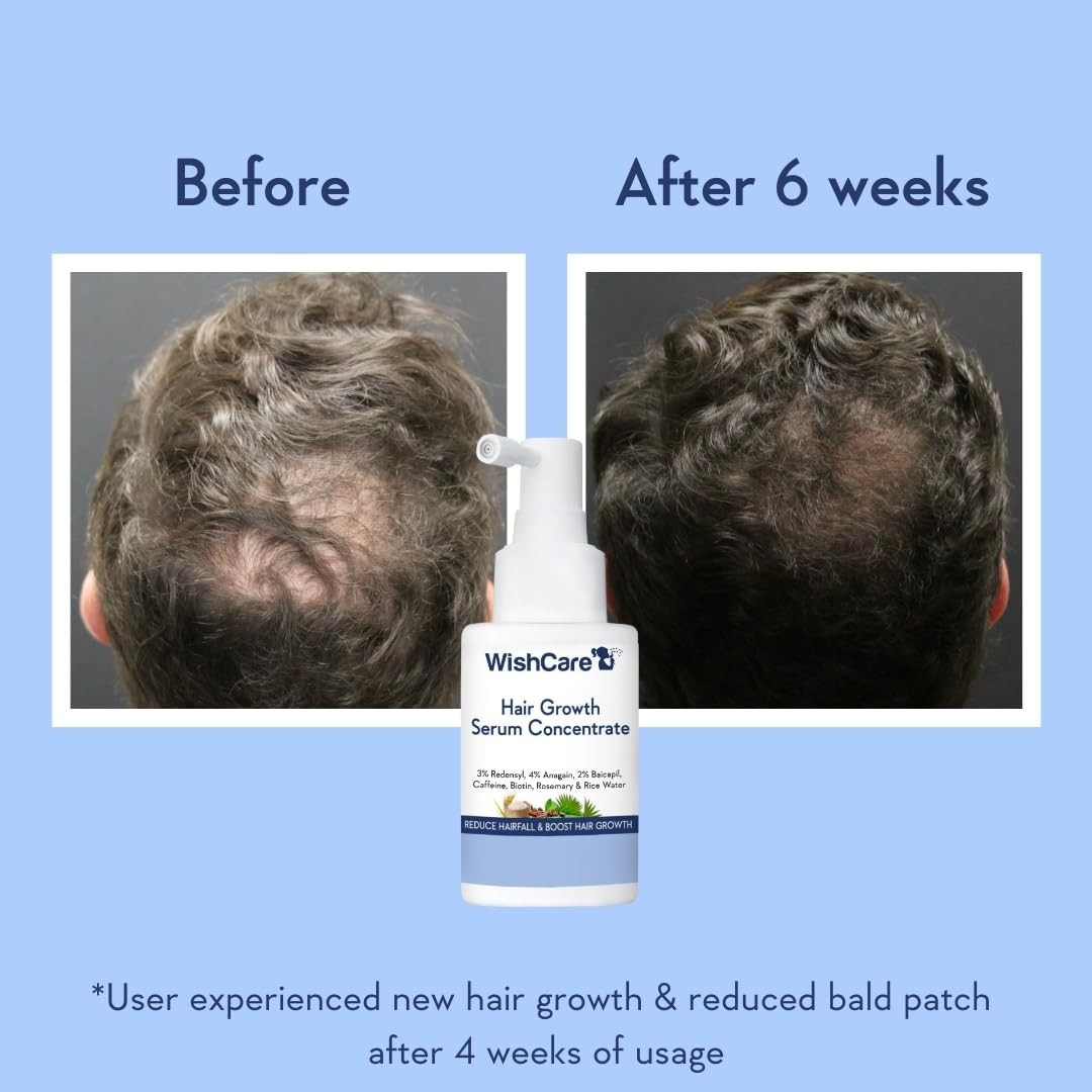 WishCare Hair Growth Serum For Scalp | 94% Saw New Hair Growth | 30ml
